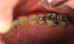Close up of smile with gray metal fillings