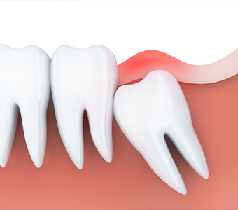 Animated wisdom tooth pushing against other teeth