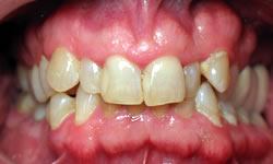Mouth with misaligned teeth