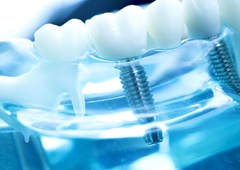 implant-supported bridge model