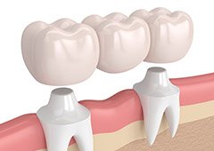 Animated fixed dental bridge being placed