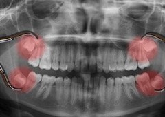 red impacted wisdom teeth