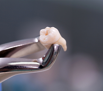 Dental forceps holding tooth after tooth extraction in Waverly