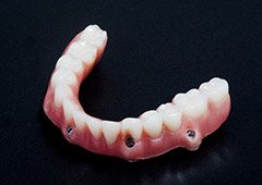Lower implant denture
