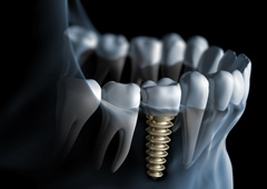 Illustration of dental implant in jawbone
