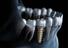 X-ray illustration of dental implants in Waverly