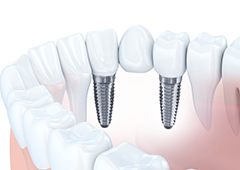 illustration of multiple implants