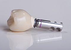 dental implant example