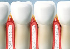 Animated row of teeth with red gums needing gum disease treatment in Waverly