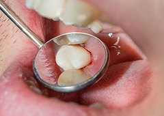 Close up of dental mirror inside of mouth