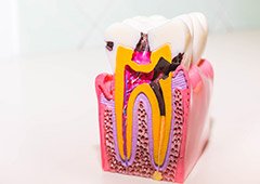 plastic model of tooth