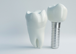 A regular tooth standing next to a single tooth dental implant