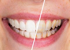 Split image of smile before and after teeth whitening