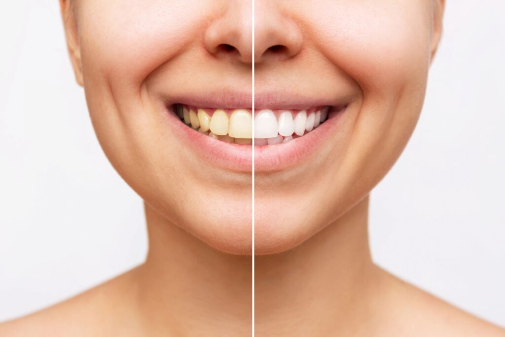 Nose-to-shoulder view of woman smiling with teeth showing before/after whitening