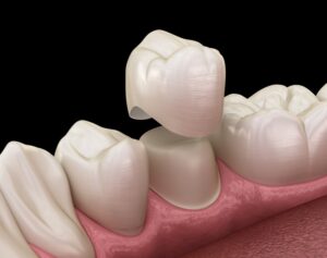 Animated rendering of dental crown.