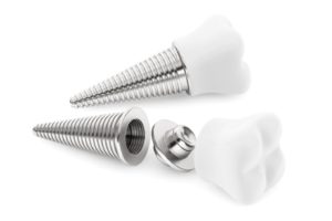 dental implants