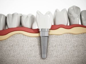 Representation of dental implant