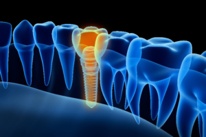 3D image of dental implants