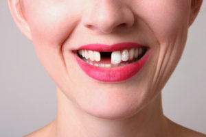 Your dentist in Lincoln creates implant-retained dentures