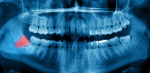 Wisdom teeth often cause more problems than they solve, but your dentist in Waverly can help. 