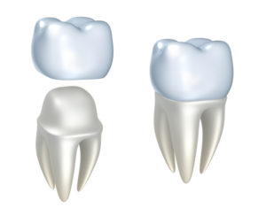 Amberly Dental offers same day crowns in Waverly.