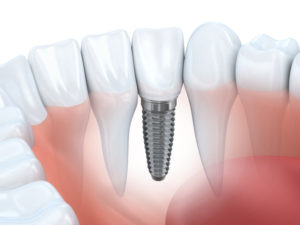 dental implants in waverly ne